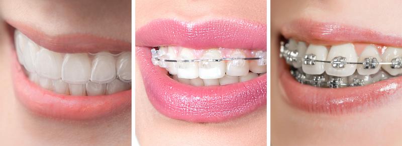 Which is better: clear aligners, invisible braces or metal braces? Three smiles depicting the differences between types of dental procedures "