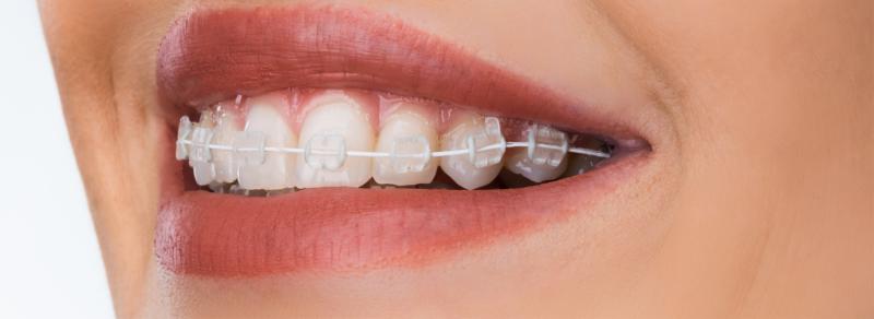 Female mouth smiling with ceramic braces or clear braces