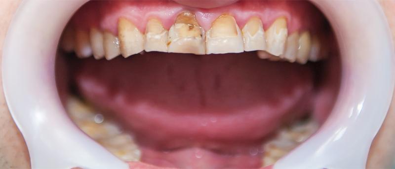 Person's mouth with signs of tooth remineralization