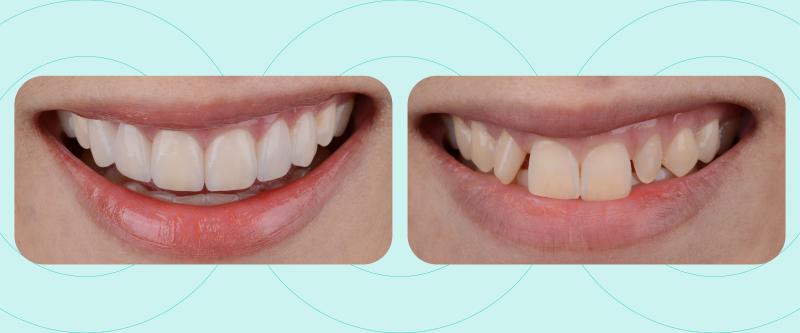 Are straight teeth better than crooked teeth? Differences between a straight teeth smile and a crooked teeth smile. 