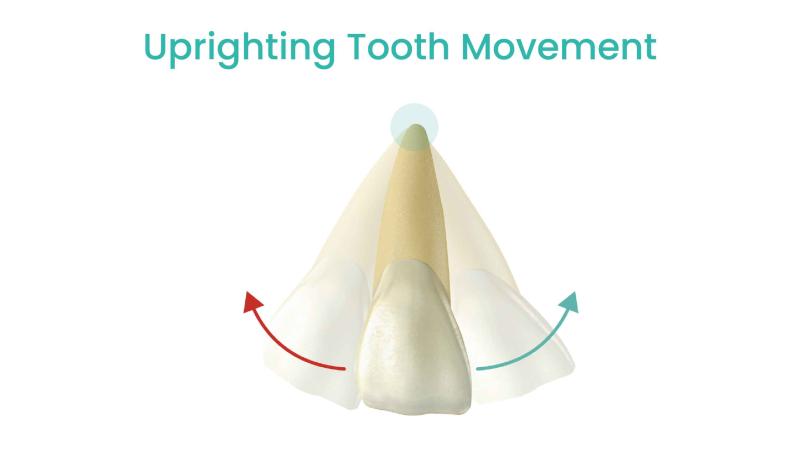 uprighting movement of teeth 