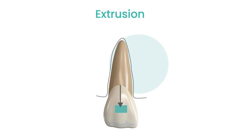 extrusion tooth movement