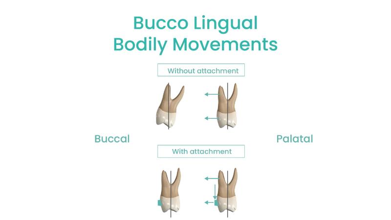 bodily orthodontic tooth movement