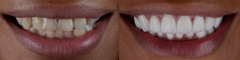 Image depicting dental veneers or porcelain veneers before and after in a men.