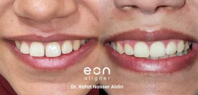 Case study that shows the before and after process of gap teeth treatment with clear aligners from Eon Aligner