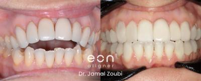 Image depicting a before and after treatment with clear aligner of an open bite issue.