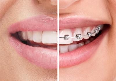 smiling person with clear aligners versus a smiling person with metal braces
