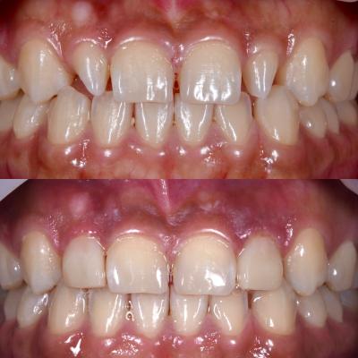 Teeth reshaping or tooth recontouring to change the shape, size, and/or surface. Image depecting the before and after of a patient.