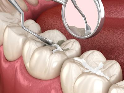 What are fissure sealants? Image of a precautionary treatment to prevent dental caries in pits and fissures. 