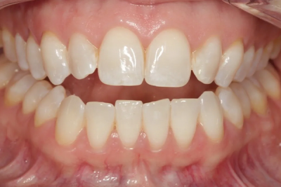 teeth showing anterior open bite 
