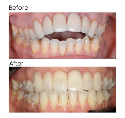 image of before and after open bite treatment 