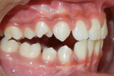 teeth showing Posterior open bite 