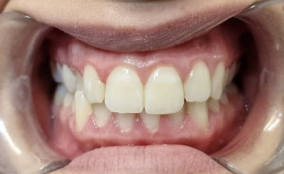 Image of a single tooth crossbite case as part of the evaluation process prior to treatment