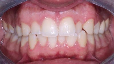 Single tooth anterior crossbite real case in which the patient can not have an adequated bite
