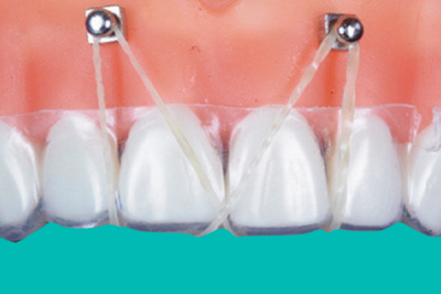Temporary Anchorage devices for treatment of open bite
