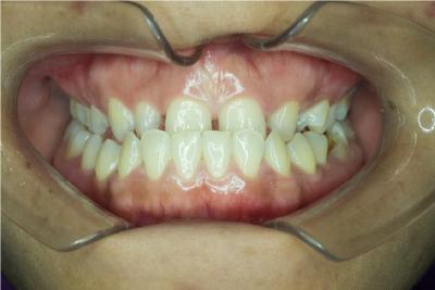 Picture of a real case of underbite in which the upper front teeth are behind the lower ones