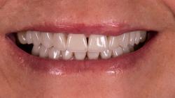 "Black triangles between teeth. Triangular tooth shape  that can be fixed with clear aligner treatment "