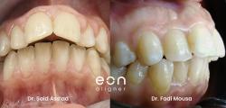 Front teeth protrusion case study related to Interproximal Reduction and its benefits for the orthodontic treatment.